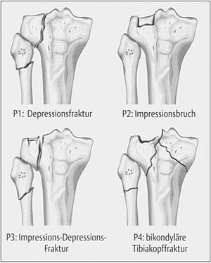 Einteilung der Schienbeinkopfbrüche
