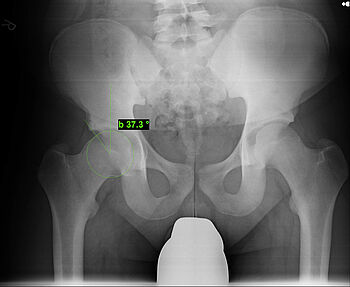 Kombiniertes Femoro-acetabuläres Impingement (Centum-Eck-Winkel 37,3°)