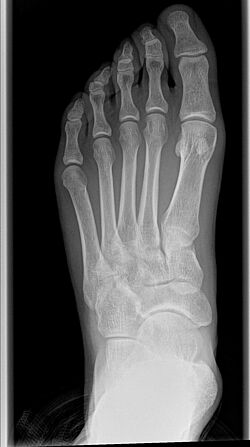 Röntgenbild eines gesunden Fußes