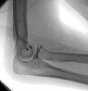 Rekonstruktion des Radiuskopfes mit zwei mini-Schrauben und die Refixation der am Oberarmknochen abgerissenen Außenbänder mit kleinen Ankern aus Titan