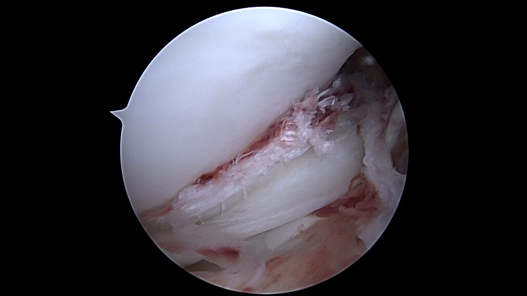 Eingeklemmter Aussenmeniskus - Korbhenkelriss