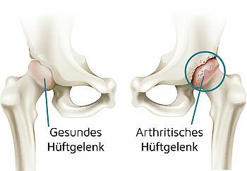 Unterschied gesundes Hüftgelenk und arthrotisches Hüftgelenk