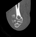 Distale Humerustrümmerfraktur mit vielen kleinen Fragmenten der Gelenkfläche