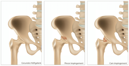 Illustration der verschiedenen Arten eines Impingement-Syndrom der Hüfte (© Sakurra, stock.adobe)