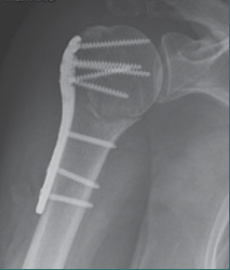 Stabilisierung eines Oberarmkopfbruches mit Platte und Schrauben