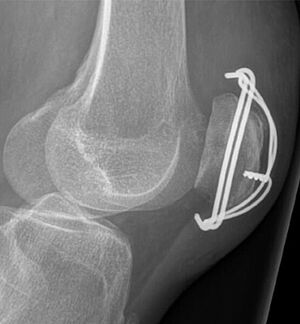 „Zuggurtungs-Osteosynthese“ mit Drähten und Draht-Cerclage zur operativen Versorgung der gebrochenen Kniescheibe.