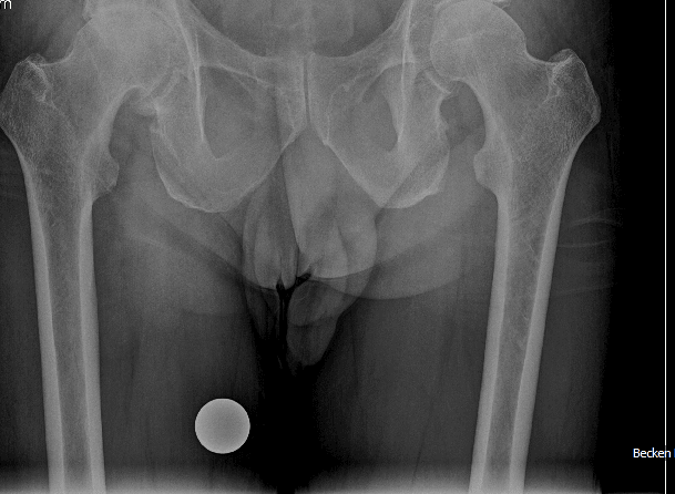 Fortgeschrittene Hüftarthrose des rechten Hüftgelenks mit komplett aufgehobenem Gelenkspalt, Indikation zur Hüft-TEP