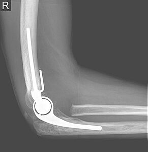 Versorgung mit dem Einbau einer gekoppelten Ellenbogenprothese.