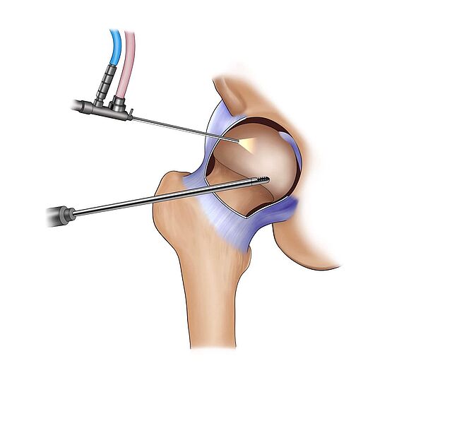 Die schematische Darstellung zeigt die Funktionsweise der Hüftarthroskopie.