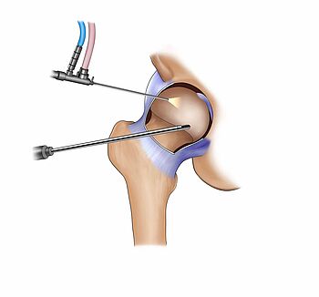 Die schematische Darstellung zeigt die Funktionsweise der Hüftarthroskopie.