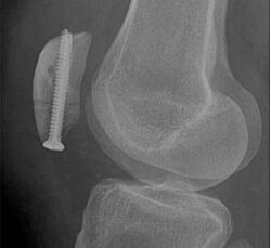 Schraubenosteosynthese mit ergänzender Sicherungsnaht zur operativen Versorgung einer Patellafraktur