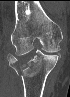 Komplizierter Schienbeinkopfbruch an der Außenseite