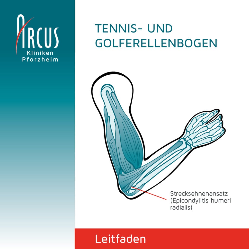 Behandlungsleitfaden Tennis- und Golferellenbogen